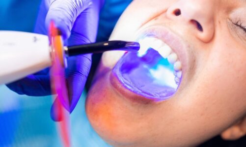 Fluoryzacja zębów: co to za zabieg, wskazania i zalecenia po leczeniu